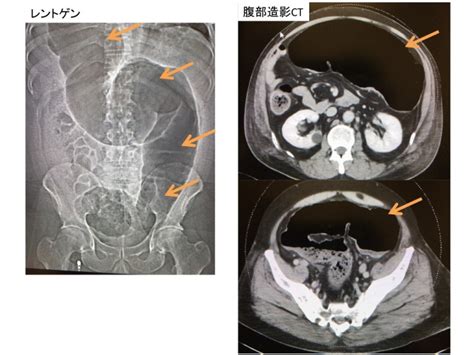 巨大結腸症とは？