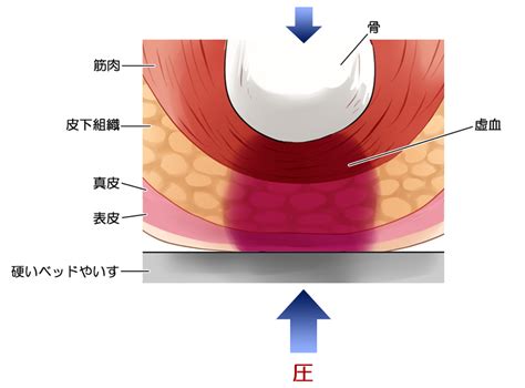 床ずれが発生する仕組み