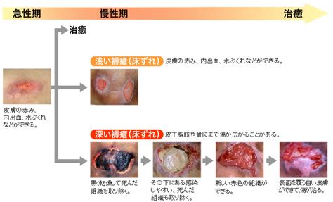 床ずれとは？