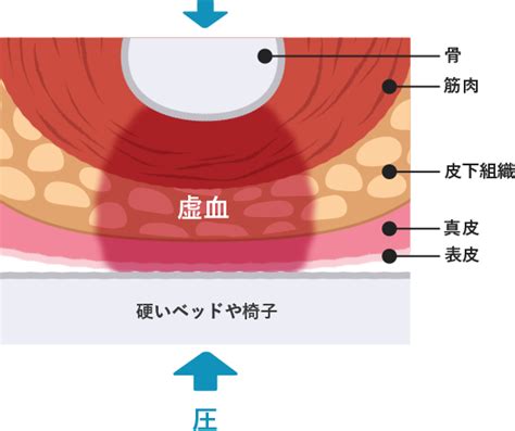 床ずれのメカニズム