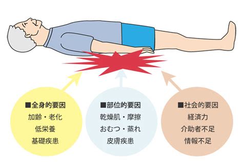 床ずれの原因