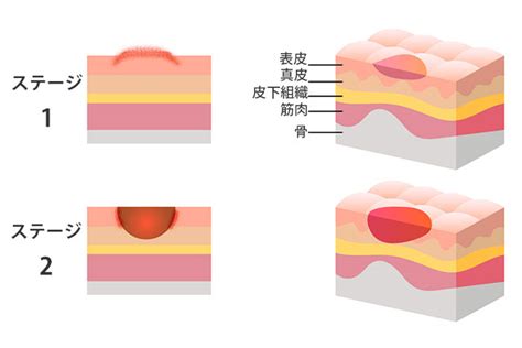 床ずれは痛いだけでなく、感染症やその他の合併症を引き起こす可能性があります。床ずれを防ぐためには、以下の対策を取ることが重要です。