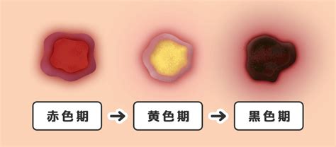 床ずれ対策のすべて：予防から治療まで徹底解説