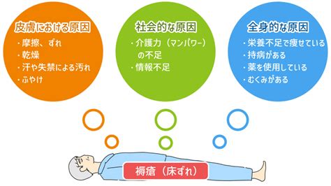 床ずれ対策の全て：予防から治療まで徹底解説