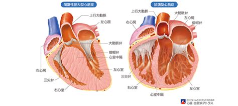 心筋症: