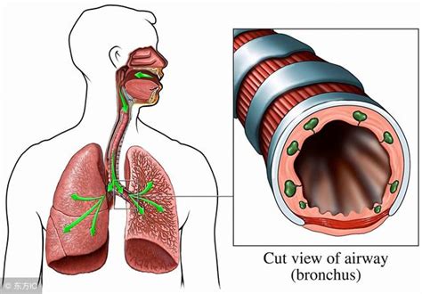 支氣管疾病的盛行