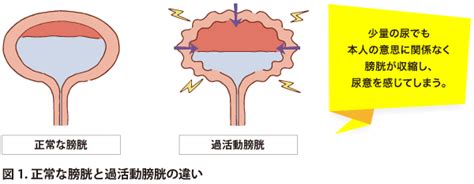 敏感な膀胱: