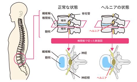 椎間板ヘルニア：