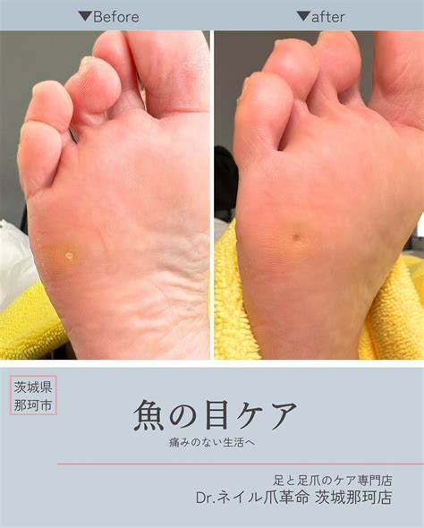 歩きづらい足に革命を起こす！足トラブルを徹底改善ガイド