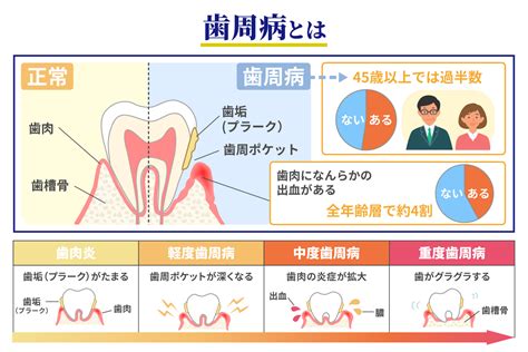 歯周病の prevalence と影響