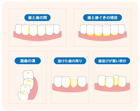 歯垢とプラークの除去: