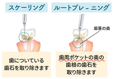 歯石を取り除くための徹底ガイド - 歯石トルンで歯と歯茎の健康を守る