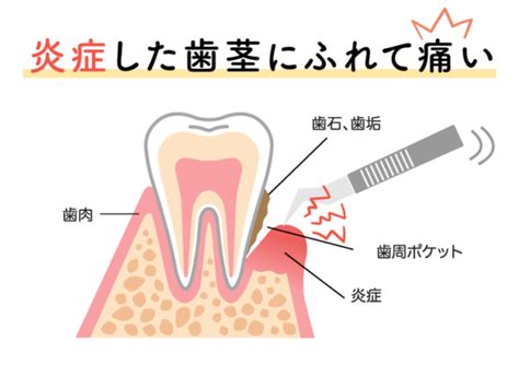 歯石除去と予防：健康な歯茎と輝く笑顔のために