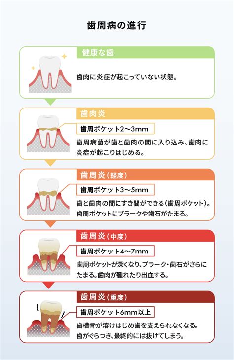 歯肉炎の軽減：