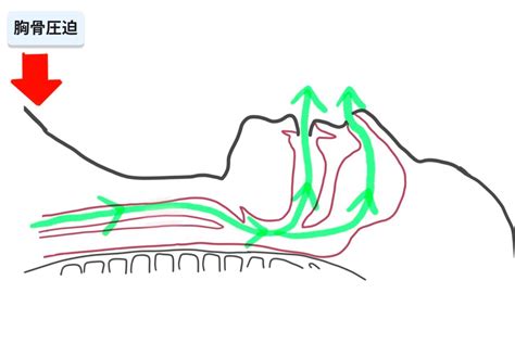 気道圧迫：
