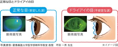 涙が不足したり、質が低下したりして目の表面が乾く状態