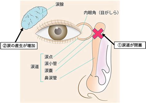 涙道閉塞：