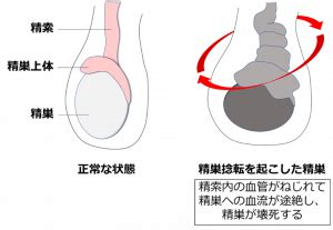 片側の睾丸の腫れ