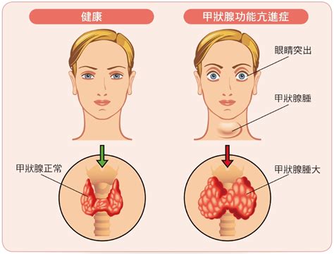 甲狀腺機能亢進者：