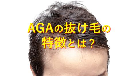 男性型脱毛症（AGA）：