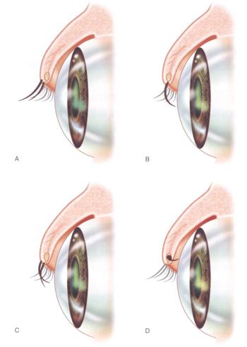 異所性睫毛のすべて：原因、症状、治療法