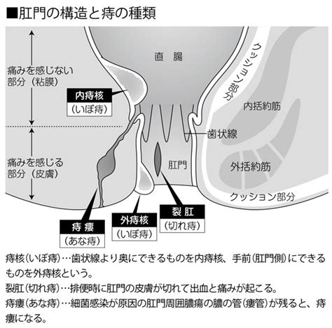 痔褥創（じじょくそう）