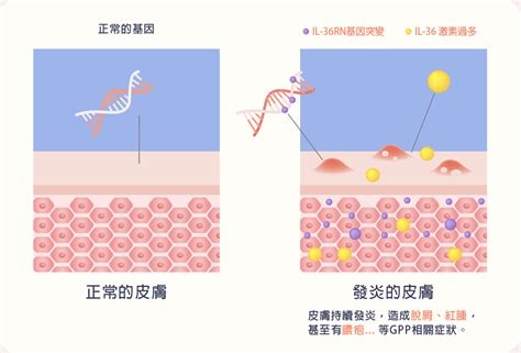 癬 傳染：你不可不知的傳播途徑與預防之道