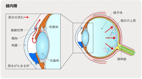 目の水晶体や緑内障の治療に使用される