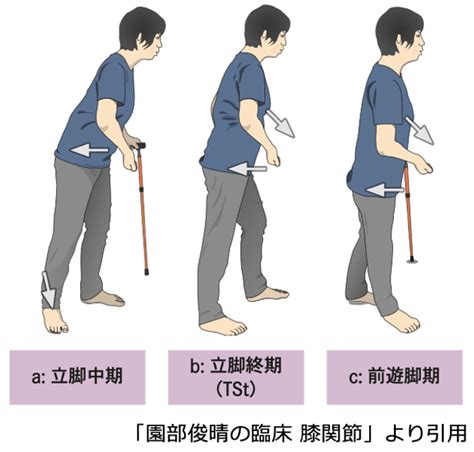 真っ直ぐ歩けない左に傾く：原因、改善方法、治療法