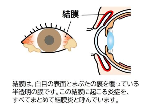 結膜炎とは？