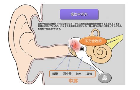 耳感染症: