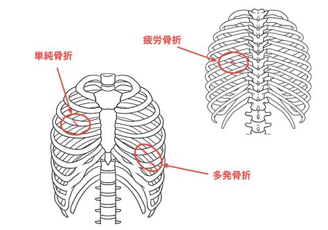 肋骨が浮いている：原因、症状、治療法