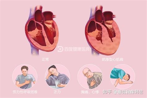 肥厚型心肌病: