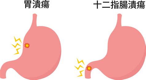 胃潰瘍または十二指腸潰瘍: