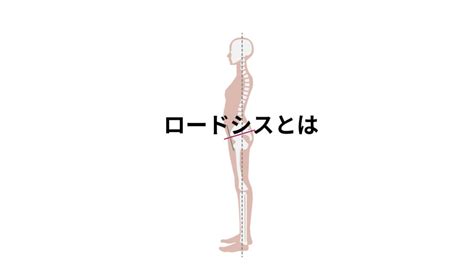 腰椎ロードシスとは？