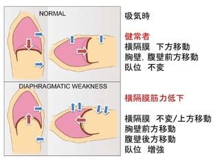 腹壁の筋力低下: