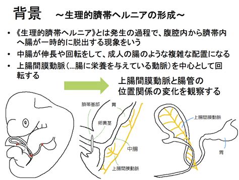 臍帯ヘルニア：