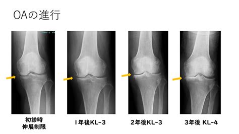 軟骨異形成症（OA）：