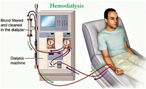 透析中文：理解您的肾脏护理选择 (Dialysis 中文: Understanding Your Kidney Care Options)