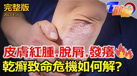 錢癬：隱藏的健康危機，不可忽視