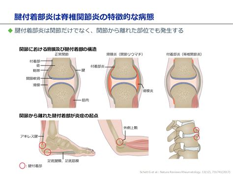 関節炎とは？