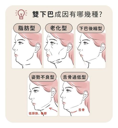 雙下巴成因：從脂肪堆積到肌肉鬆弛