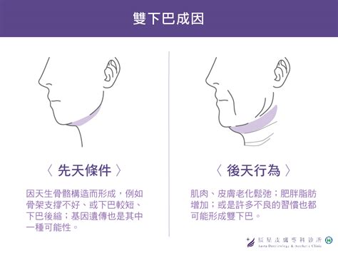 雙下巴：成因、預防和治療