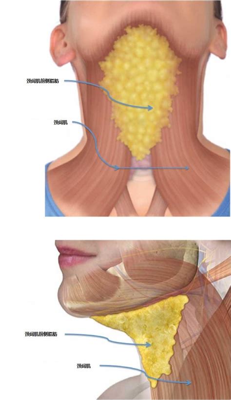 颏下脂肪堆积