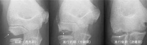 骨軟骨異形成症（OCD）とは？