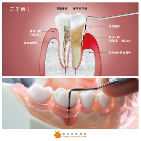 骨領：牙周病治療的尖端技術