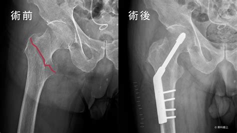 骨頭衣領，癒合骨頭斷裂的革命性解決方法