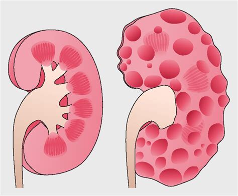 1. 多発性嚢胞腎（PKD）