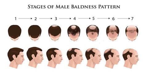 1. Androgenetic Alopecia (Male-Pattern Baldness)