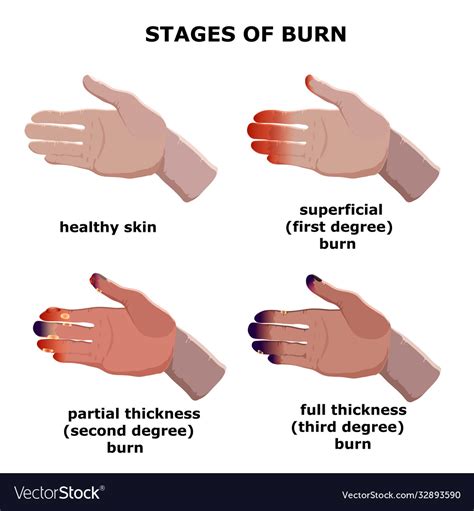 1. Burning Hands: